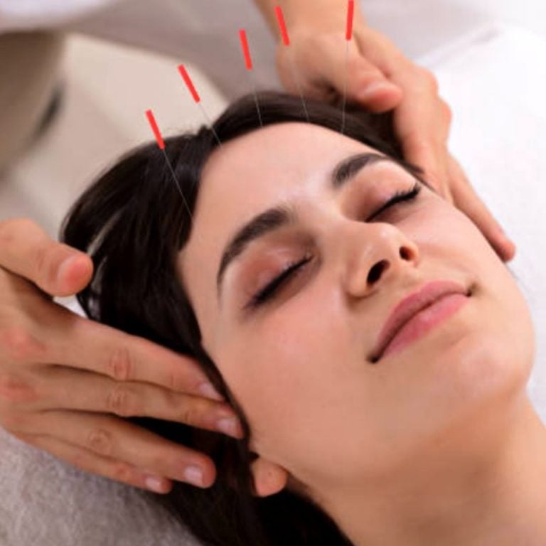 Acupuncture at Thai Wellness Spa